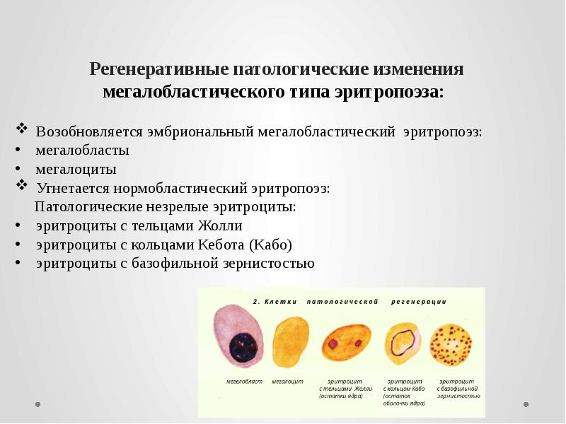 Регенеративные патологические изменения мегалобластического типа эритропоэза:  Возобновляется эмбриональный мегалобластический эритропоэз:
