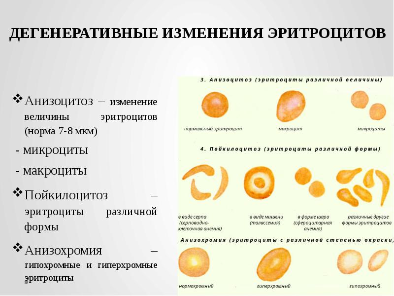 Анизоцитоз – изменение величины эритроцитов (норма 7-8 мкм)  - микроциты