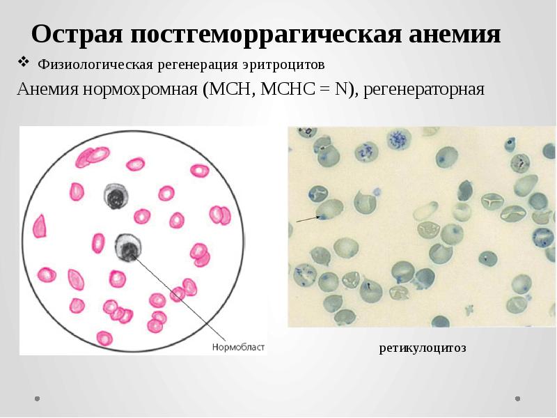 Картина крови при опга