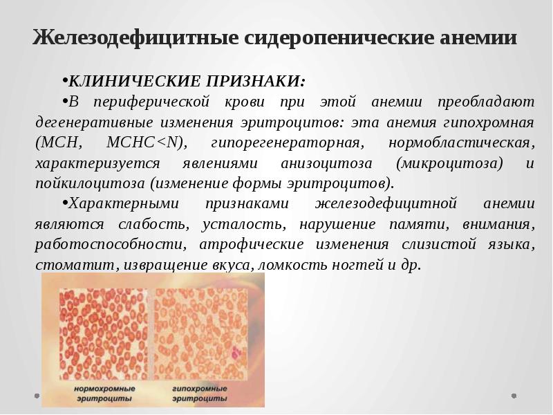 Железодефицитные сидеропенические анемии  КЛИНИЧЕСКИЕ ПРИЗНАКИ: В периферической крови при этой