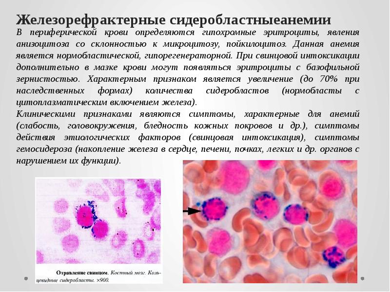 Железорефрактерные сидеробластныеанемии