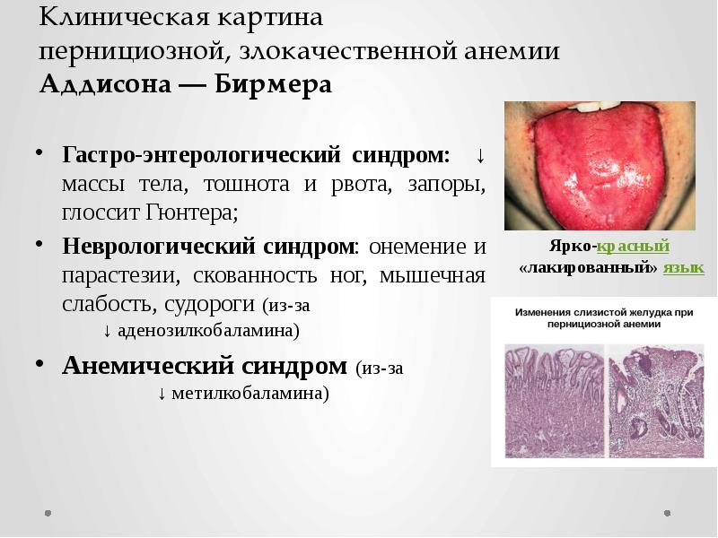 Клиническая картина пернициозной, злокачественной анемии Аддисона&nbsp;— Бирмера Гастро-энтерологический синдром: ↓ массы