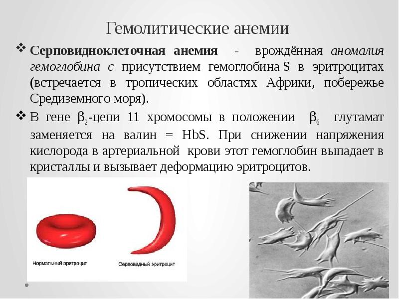 Гемолитические анемии    Серповидноклеточная анемия - врождённая аномалия гемоглобина