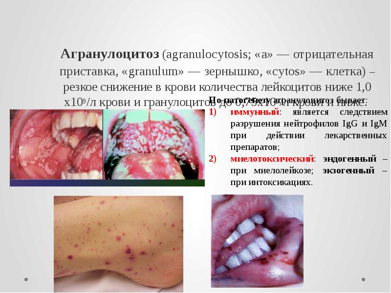 Агранулоцитоз (agranulocytosis; «a» — отрицательная приставка, «granulum» — зернышко, «cytos» —