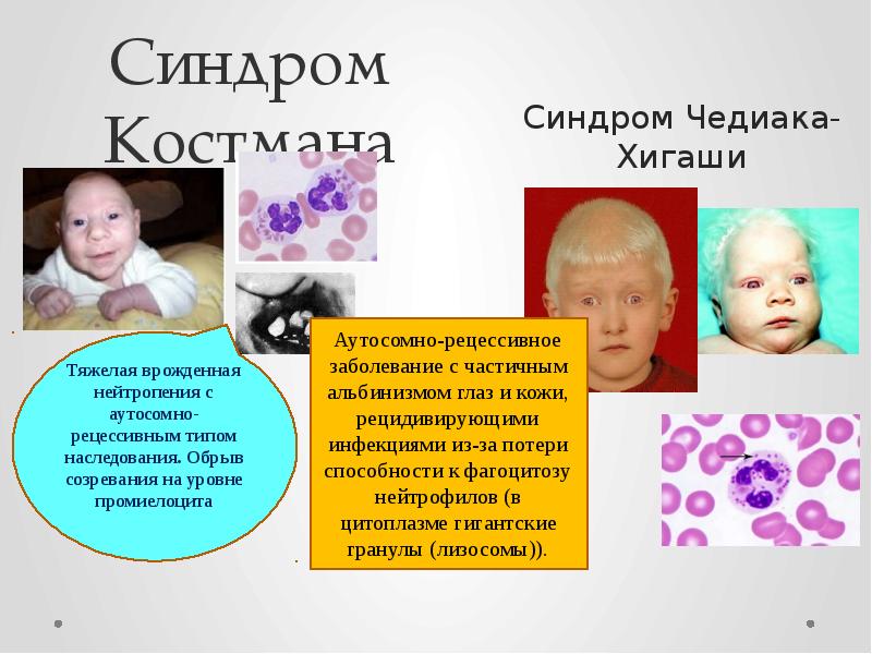 Синдром Костмана Аутосомно-рецессивное заболевание с частичным альбинизмом глаз и кожи, рецидивирующими