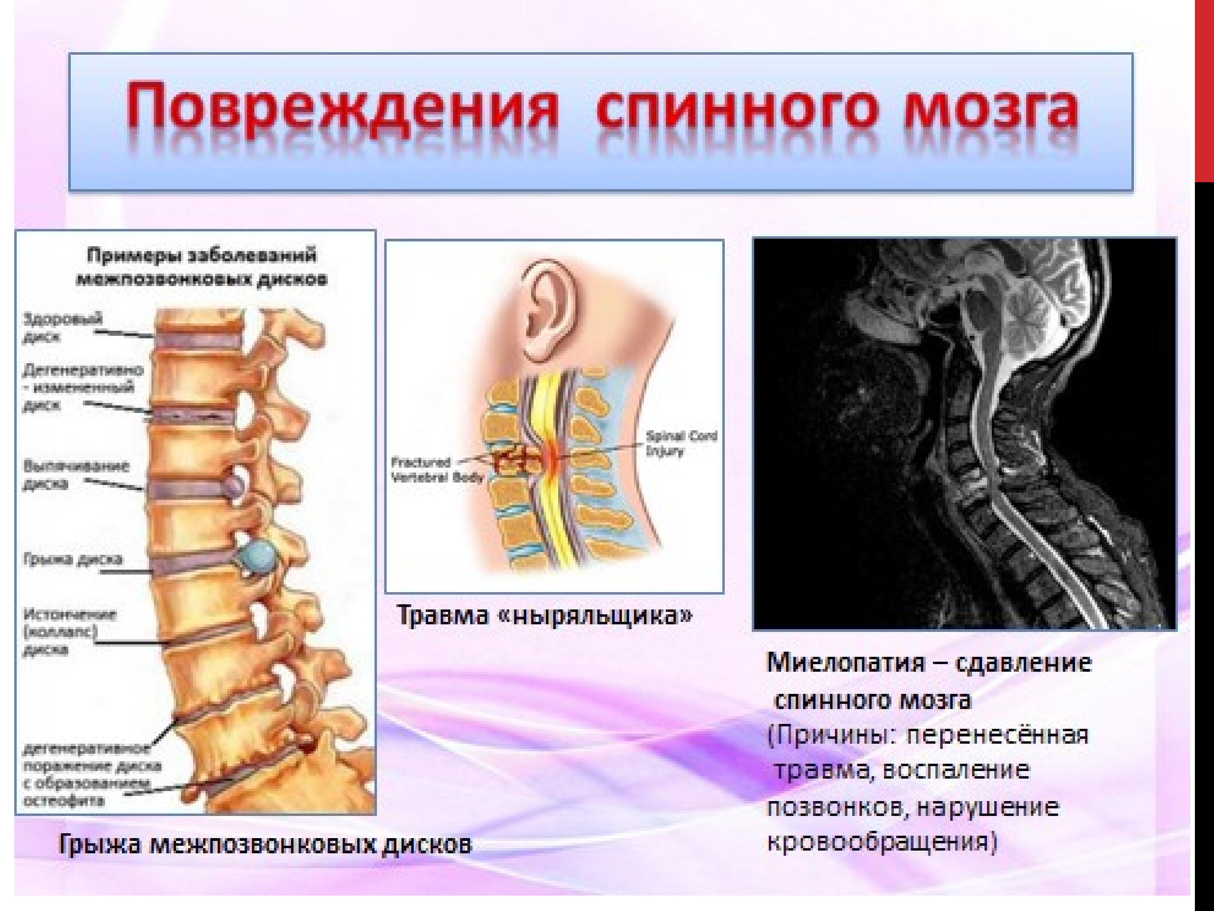 Травмы позвоночника с повреждением. Компрессия спинного мозга при переломе позвоночника. При повреждениях спинного мозга. Осложнения. Компрессия спинного мозга травма шейный отдел позвоночника. Признаки повреждения спинного мозга.