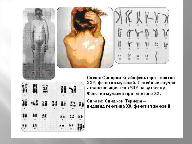 Изменения числа хромосом в кариотипе