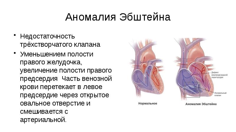 Аномалии эбштейна презентация