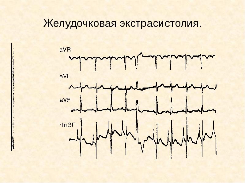 Нарушение ритма у детей презентация