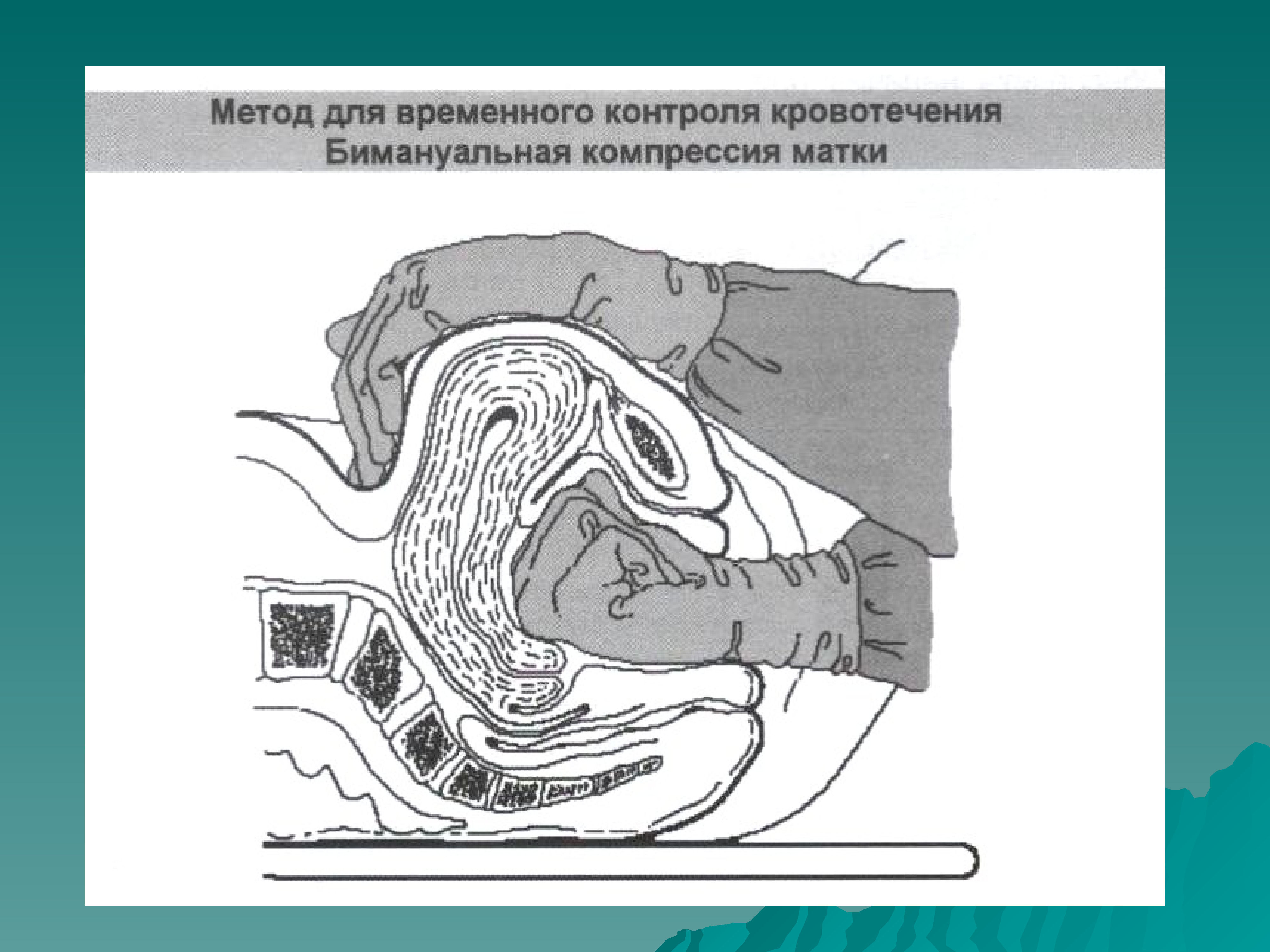 Бимануальное влагалищное исследование. Бимануальная компрессия матки показания. Бимануальная пальпация матки. Бимануальная компрессия матки техника.