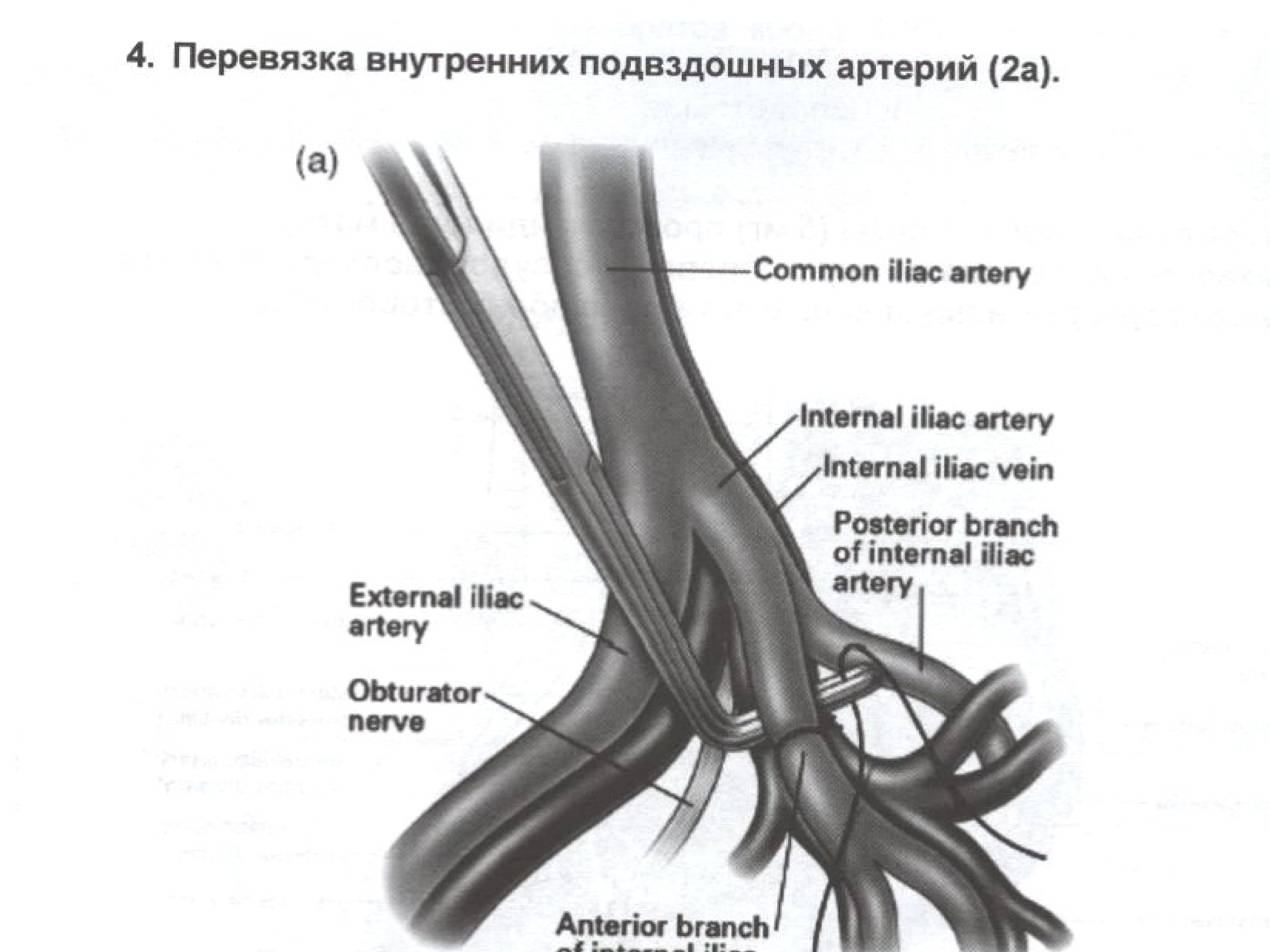 Диаметр артерии. Перевязка внутренних подвздошных артерий Акушерство. Перевязка внутренней подвздошной артерии техника. Лигирование внутренней подвздошной артерии. Перевязка внутренней подвздошной артерии показания.