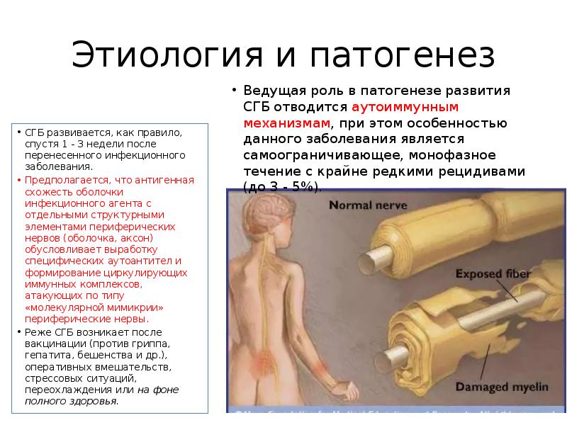 Этиология и патогенез
Ведущая роль в патогенезе развития СГБ отводится аутоиммунным Этиология и патогенез
Ведущая роль в патогенезе развития СГБ отводится аутоиммунным