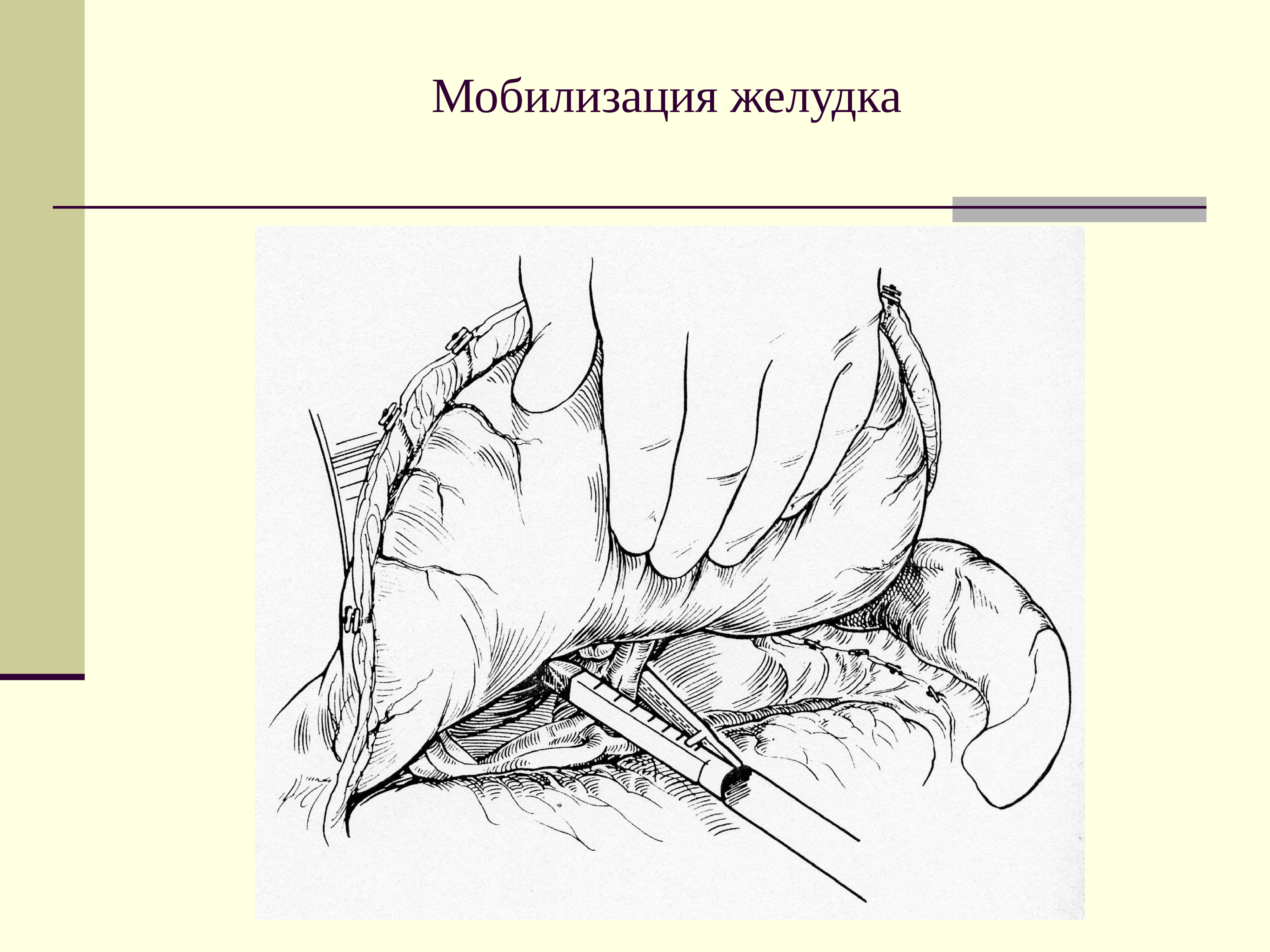 Схема мобилизации двенадцатиперстной кишки по кохеру