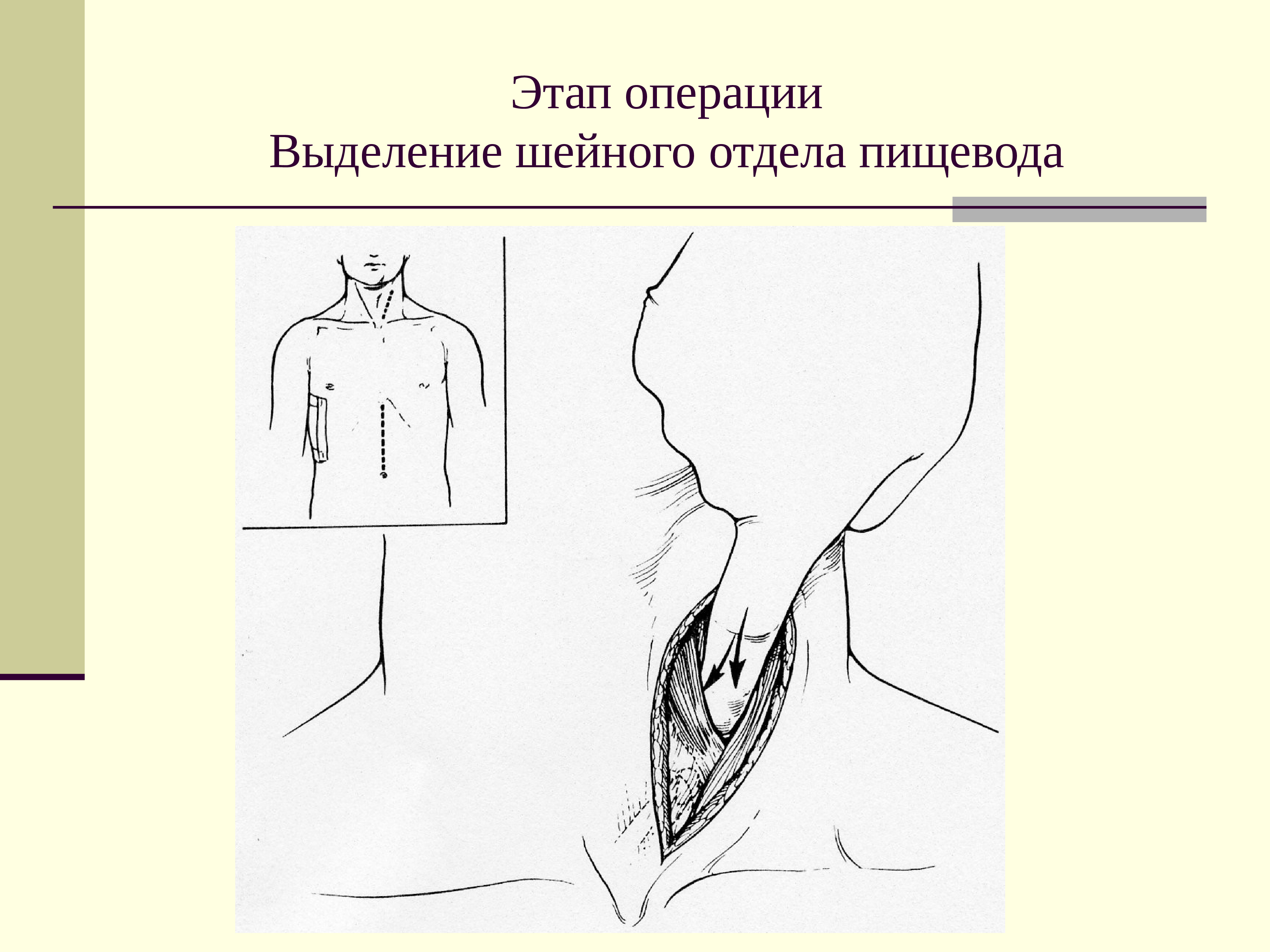 Операция выделения. Операции на шейном отделе пищевода. Доступы при операциях на пищеводе. Доступ к шейному отделу пищевода.