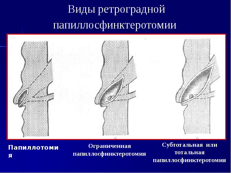 Эндоскопическая папиллосфинктеротомия презентация