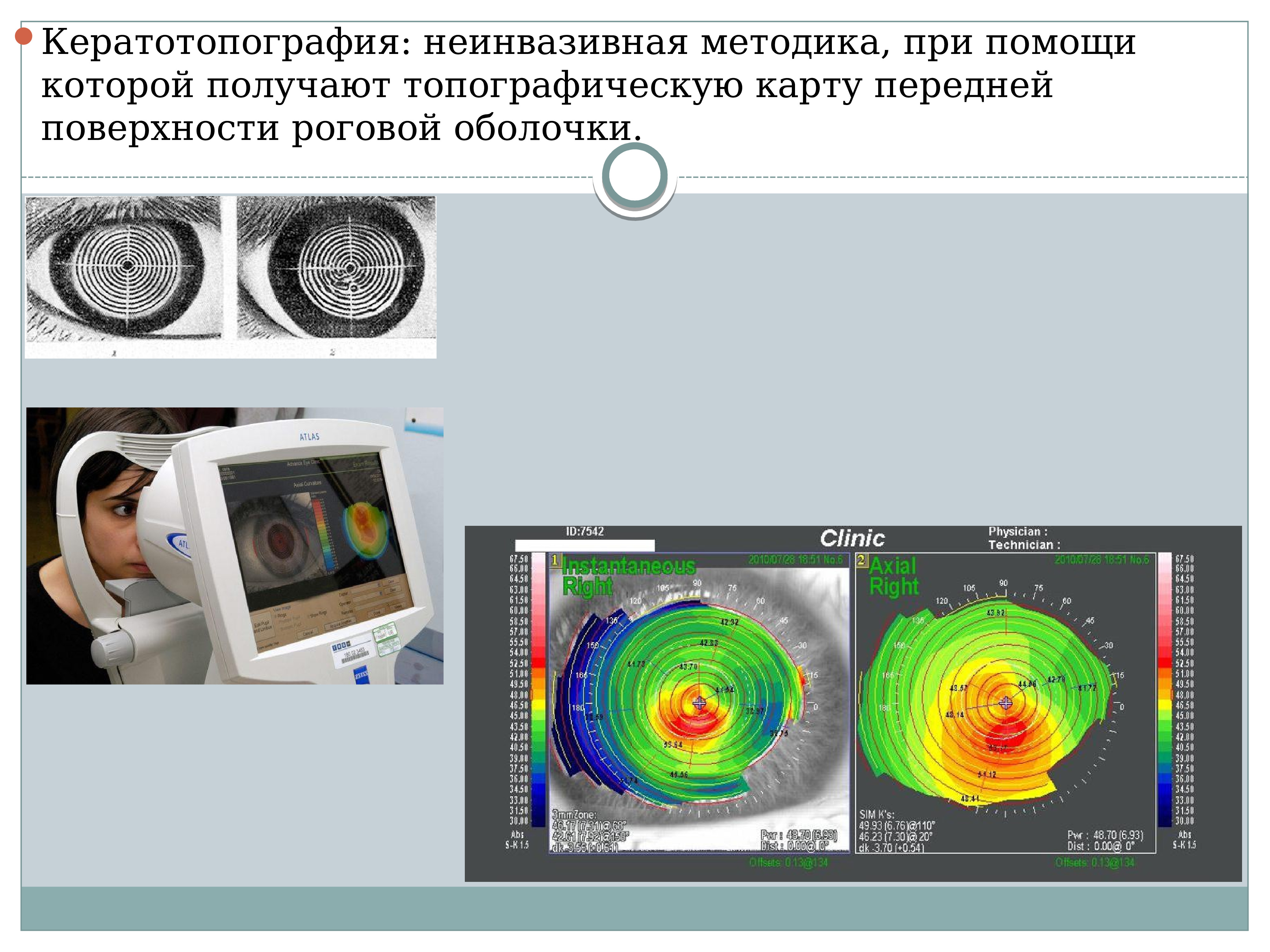 Кератоконус кератотопограмма. Кератотопография глаза что это. Кератотопография глаза. Кератоконус топография роговицы. Кератоконус кератотопограмма.