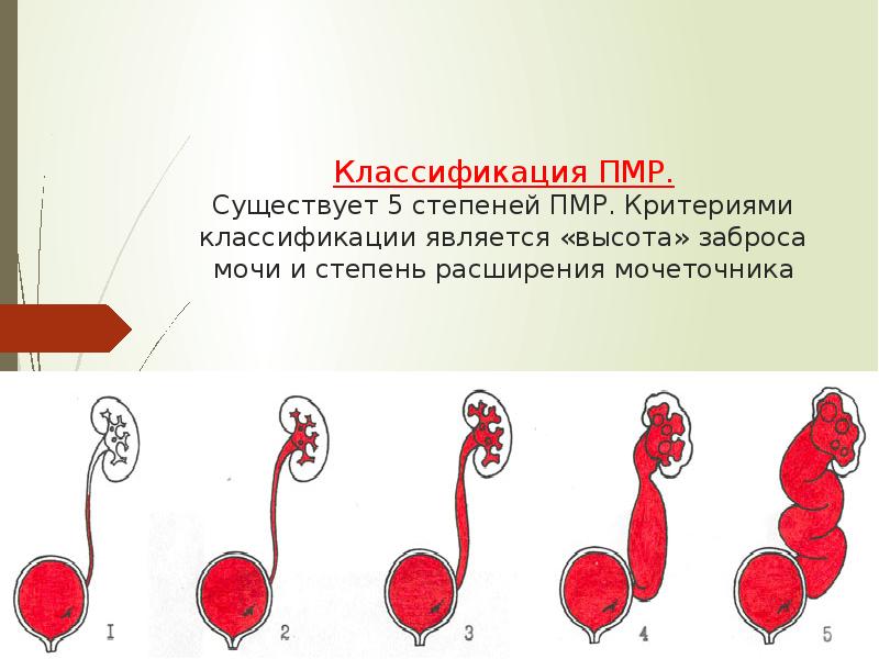 Пузырно мочеточниковый рефлюкс презентация