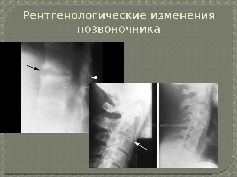 Анкилозирующий спондилоартрит презентация