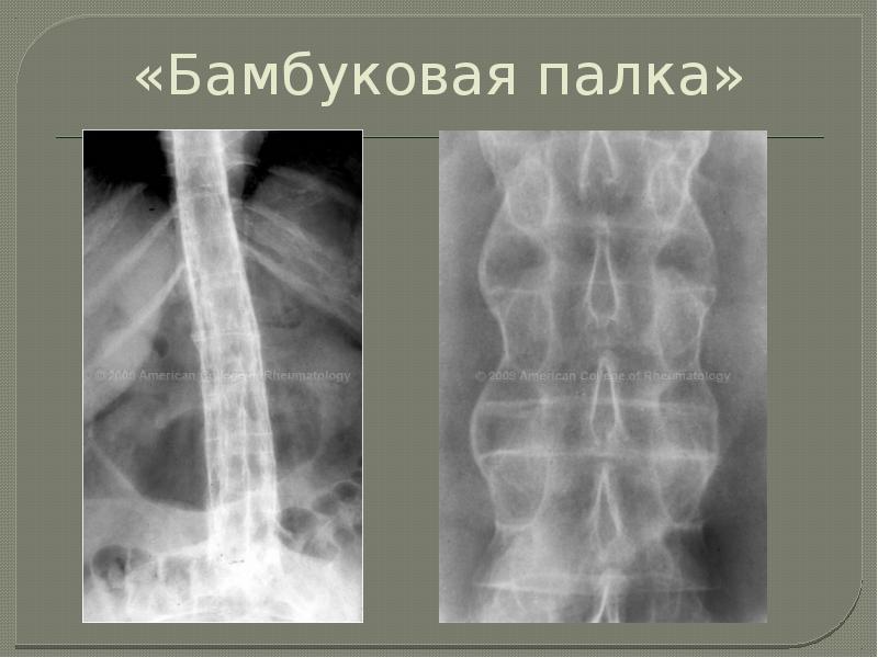 Анкилозирующий спондилоартрит презентация