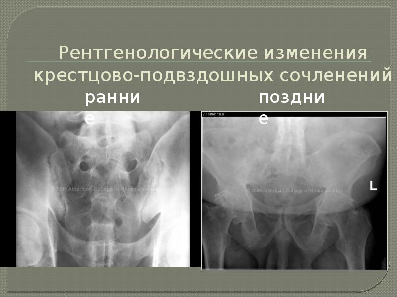 Анкилозирующий спондилит презентация