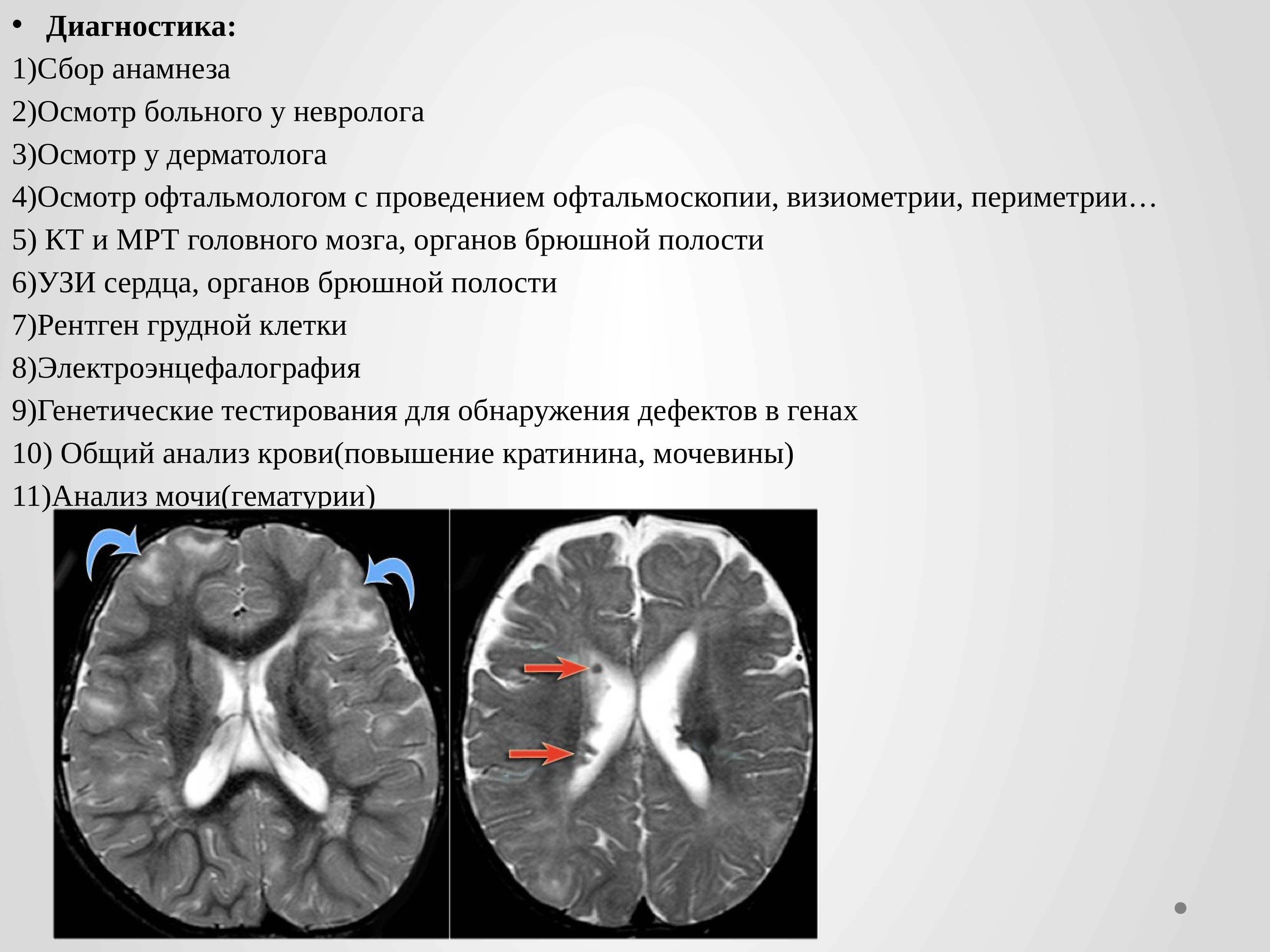 Туберозный склероз презентация