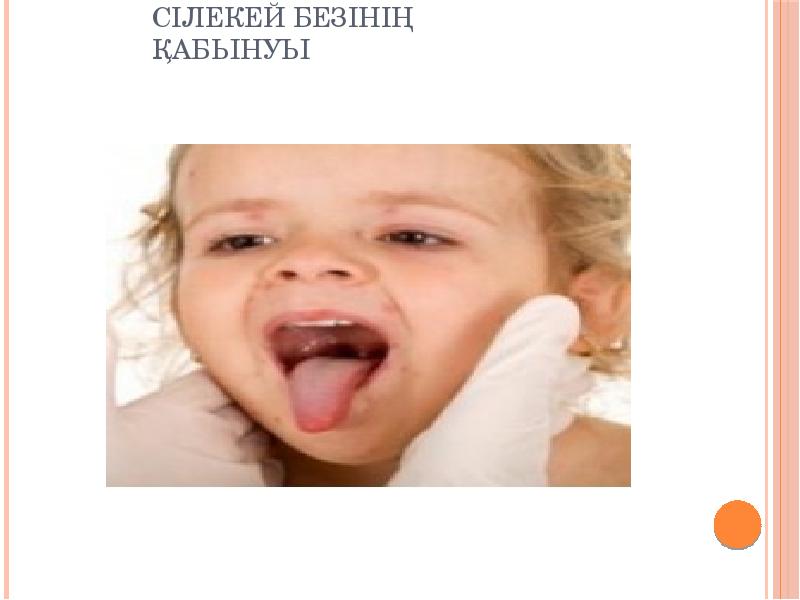 Сілекей безінің қабынуы Сілекей безінің қабынуы