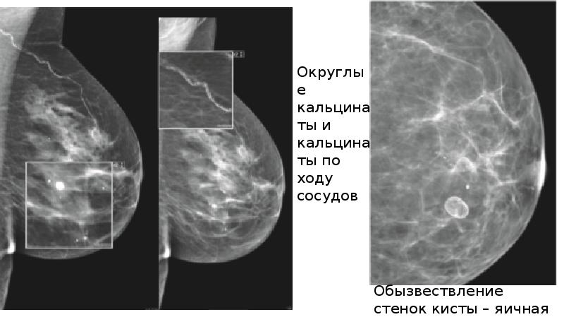 Маммография молочных желез как делают часто. Киста молочной железы на маммографии. Разнокалиберные кальцинаты. Обызвествленная киста на маммографии.