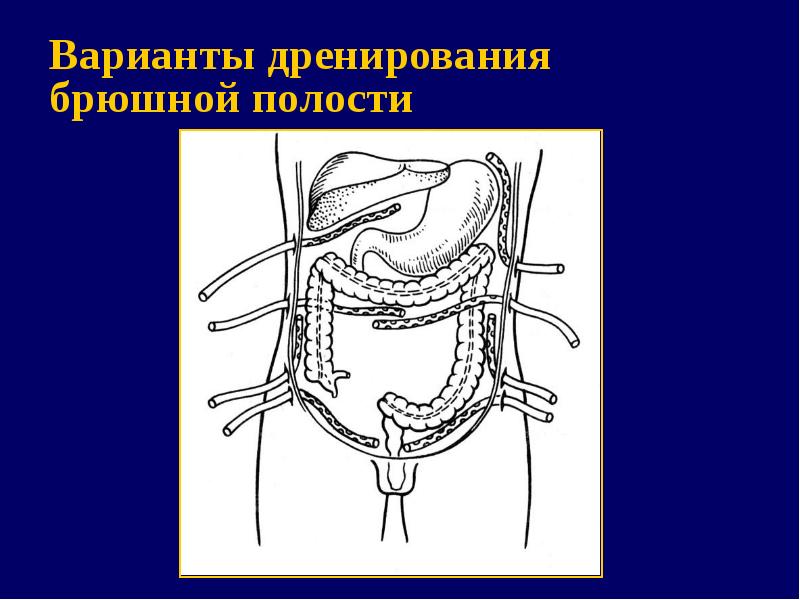 Полость проникнуть. Перитонит брюшной перитонит. Дренаж брюшной полости. Лапароскопическое дренирование брюшной полости.