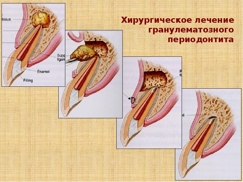 Резекция верхушки корня зуба презентация