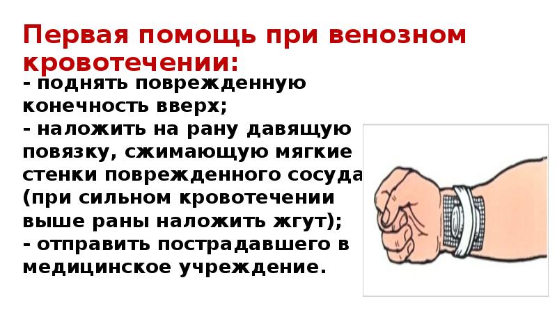 Первая необходимая помощь при кровотечениях. ПМП при венозном кровотечении. Неотложная помощь при венозном кровотечении алгоритм. Алгоритм оказания первой помощи при венозном кровотечении. Давящая повязка для остановки венозного кровотечения.