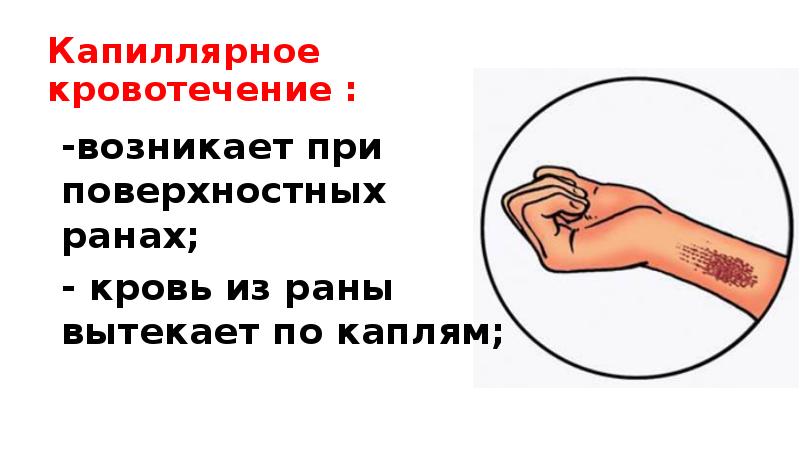 Капиллярное кровотечение первая. При капиллярном кровотечении кровь. Остановка капиллярного кровотечения. Способы остановки капиллярного кровотечения. Капиллярное кровотечение возникает при.