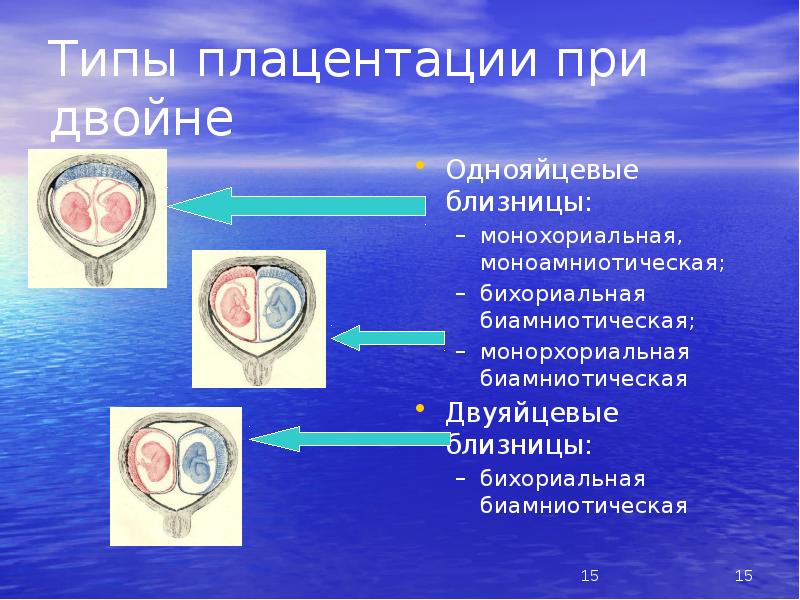 Монохориальная двойня. Монохориальная многоплодная беременность. Бихориальная биамниотическая. Бихориальная биамниотическая тройня. Бихориальная биамниотическая двойня.