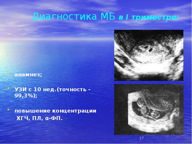 Диагностика МБ в I триместре:
анамнез;
УЗИ с 10 нед.(точность Диагностика МБ в I триместре:
анамнез;
УЗИ с 10 нед.(точность