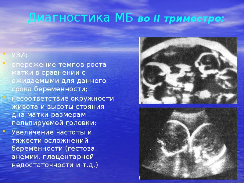 Диагностика МБ во II триместре:
УЗИ;
опережение темпов роста матки в Диагностика МБ во II триместре:
УЗИ;
опережение темпов роста матки в