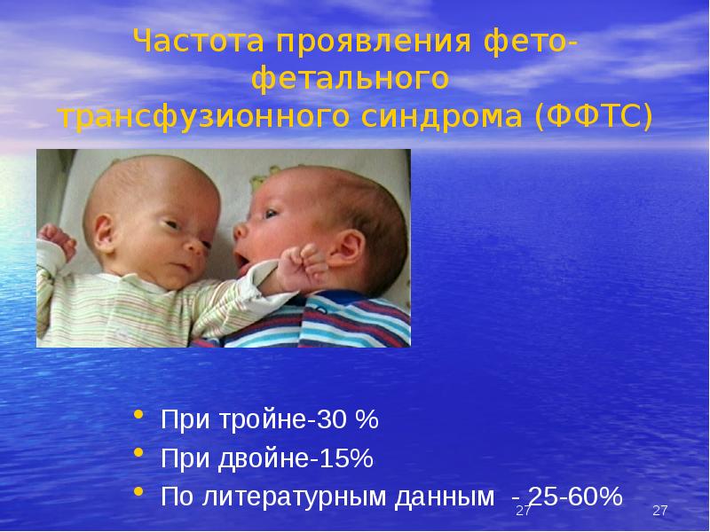 Частота проявления фето-фетального трансфузионного синдрома (ФФТС)
При тройне-30 %
При Частота проявления фето-фетального трансфузионного синдрома (ФФТС)
При тройне-30 %
При