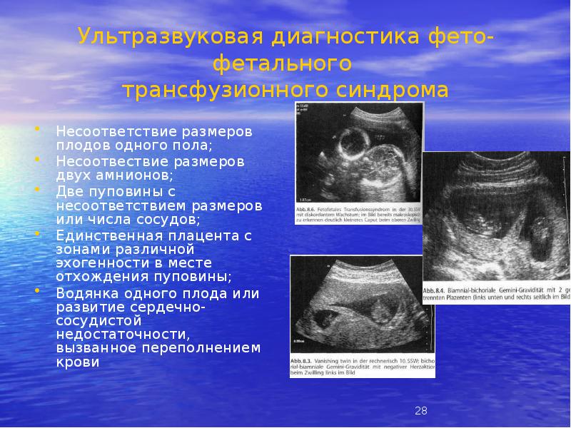Ультразвуковая диагностика фето-фетального трансфузионного синдрома
Несоответствие размеров плодов одного пола;
Ультразвуковая диагностика фето-фетального трансфузионного синдрома
Несоответствие размеров плодов одного пола;