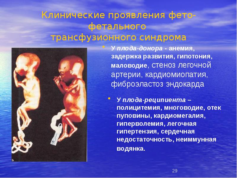 Клинические проявления фето-фетального трансфузионного синдрома
У плода-донора - анемия, задержка Клинические проявления фето-фетального трансфузионного синдрома
У плода-донора - анемия, задержка