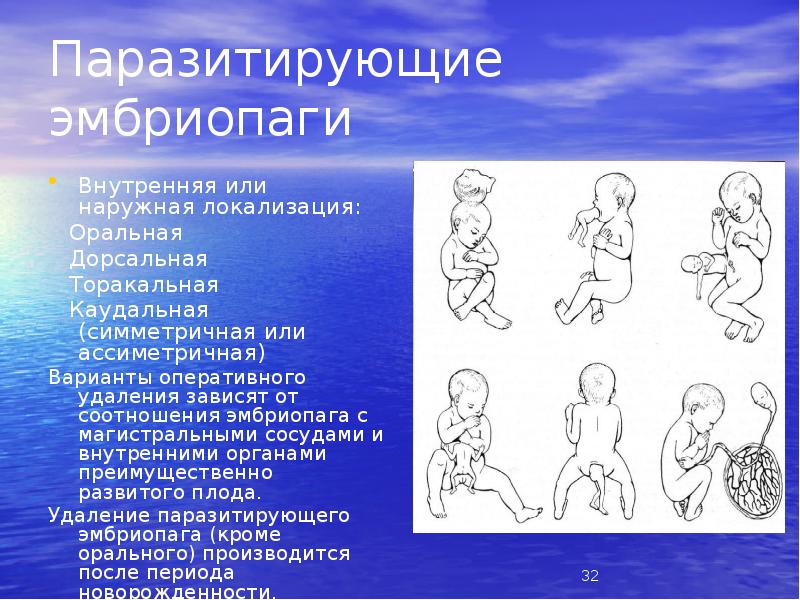 Паразитирующие эмбриопаги
Внутренняя или наружная локализация:
Оральная
Паразитирующие эмбриопаги
Внутренняя или наружная локализация:
Оральная