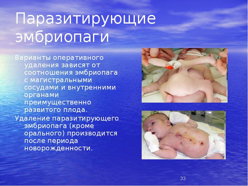 Паразитирующие эмбриопаги
Варианты оперативного удаления зависят от соотношения эмбриопага с магистральными Паразитирующие эмбриопаги
Варианты оперативного удаления зависят от соотношения эмбриопага с магистральными