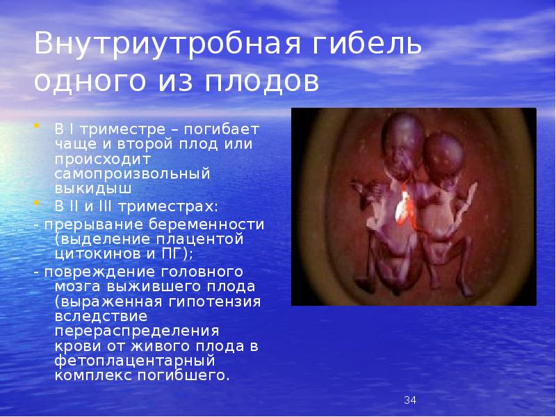 Внутриутробная гибель одного из плодов
В I триместре – погибает чаще Внутриутробная гибель одного из плодов
В I триместре – погибает чаще