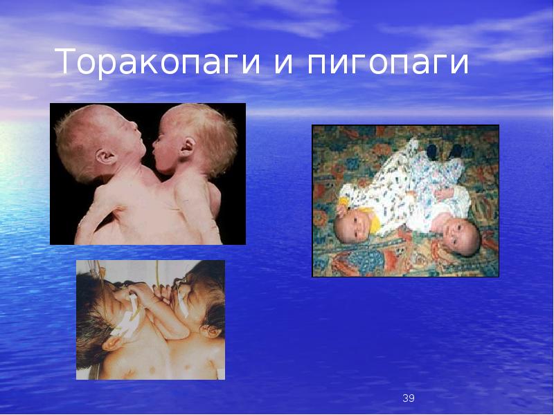 Торакопаги и пигопаги Торакопаги и пигопаги