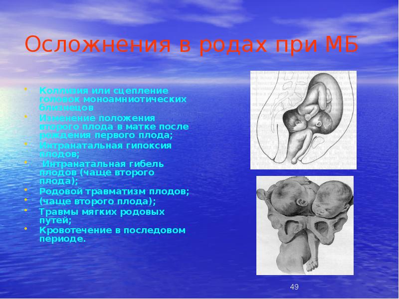 Осложнения в родах при МБ
Коллизия или сцепление головок моноамниотических близнецов Осложнения в родах при МБ
Коллизия или сцепление головок моноамниотических близнецов
