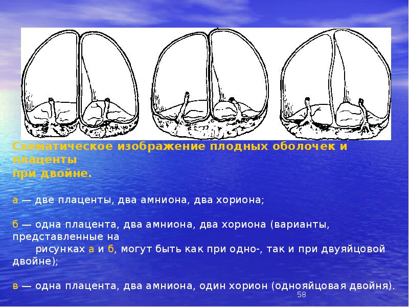 Схематическое изображение плодных оболочек и плаценты при двойне. а Схематическое изображение плодных оболочек и плаценты при двойне. а