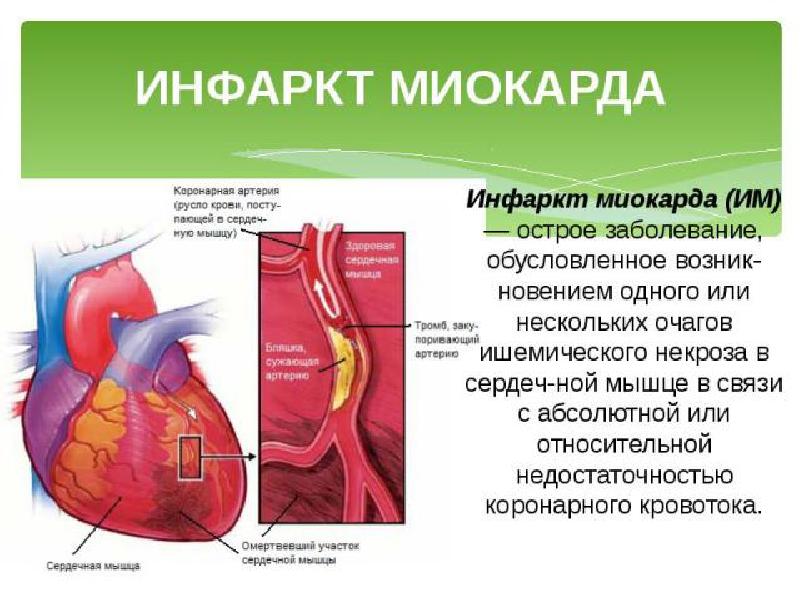 Что такое инфаркт миокарда. Перенесенный инфаркт миокарда. Ад при инфаркте миокарда.