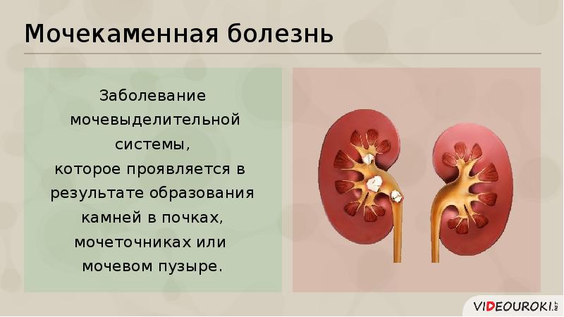 Заболевания мочевыделительной системы презентация