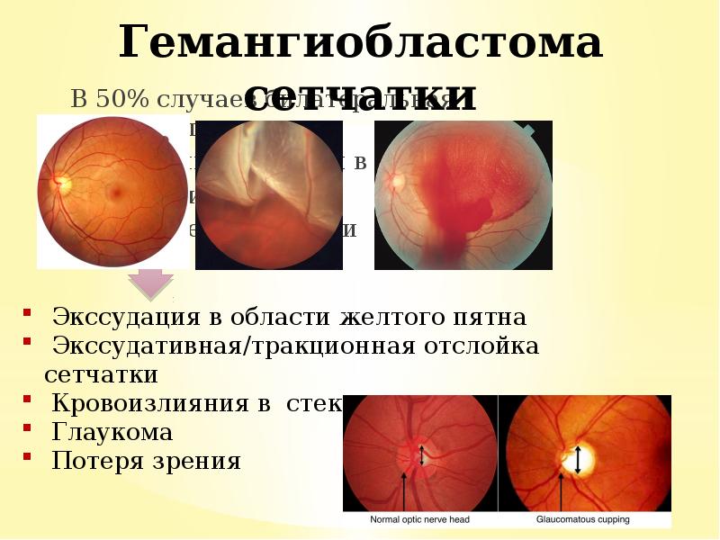 В 50% случаев билатеральная локализация
В 50% случаев билатеральная локализация В 50% случаев билатеральная локализация
В 50% случаев билатеральная локализация