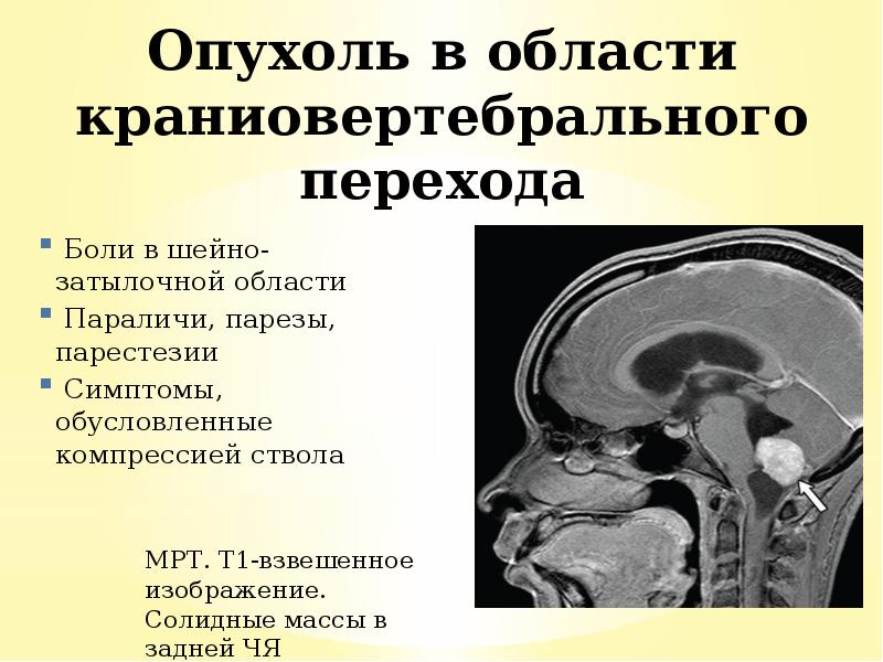 Боли в шейно-затылочной области
Боли в шейно-затылочной области
Параличи, Боли в шейно-затылочной области
Боли в шейно-затылочной области
Параличи,