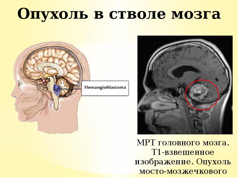 Рак ствола головного мозга. Опухоль мосто мозжечкового угла мрт. Опухоли ствола головного мозга клиника. Диффузная глиома ствола головного мозга. Объемное образование ствола головного мозга.