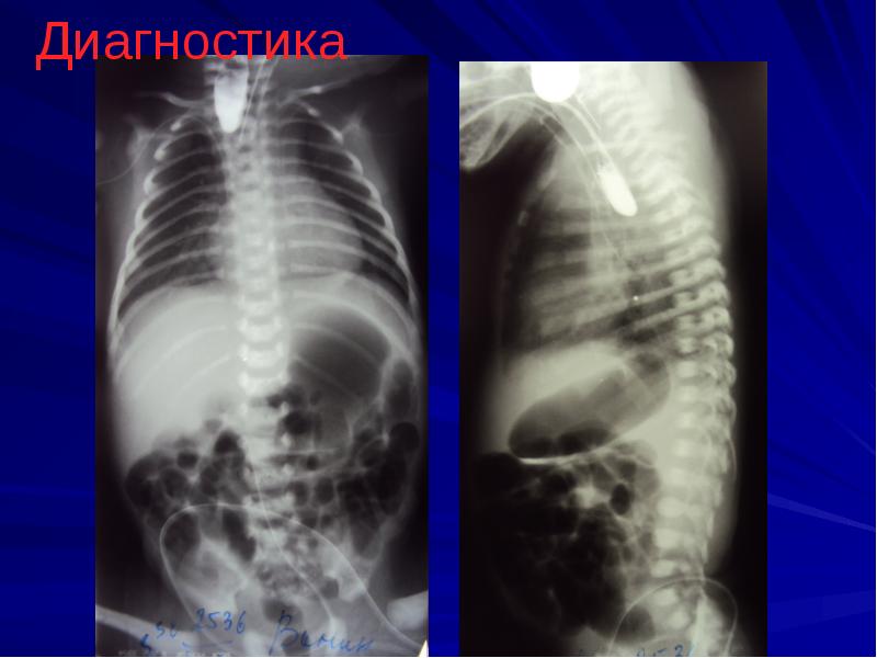 Атрезия пищевода у детей презентация