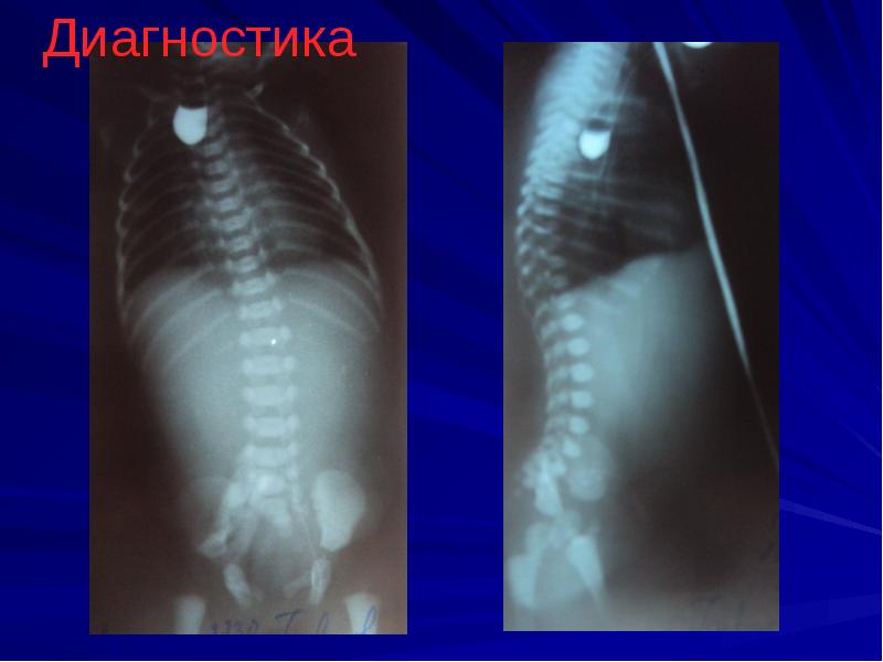 Атрезия пищевода у детей презентация